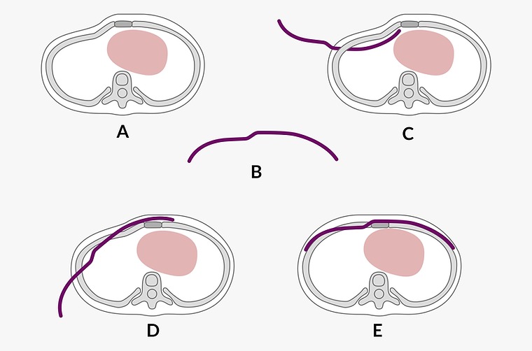 willine procedure