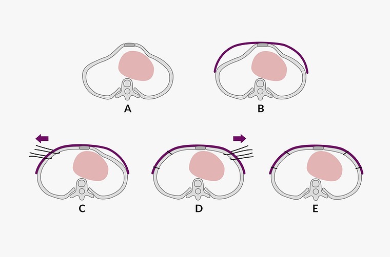 wenlin procedure