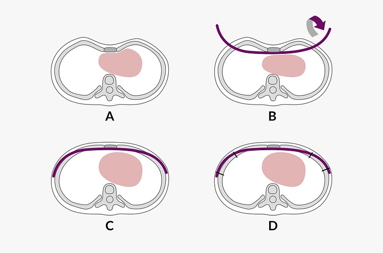 wung procedure