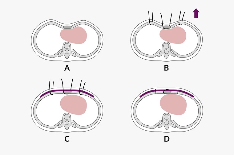 Wang Procedure